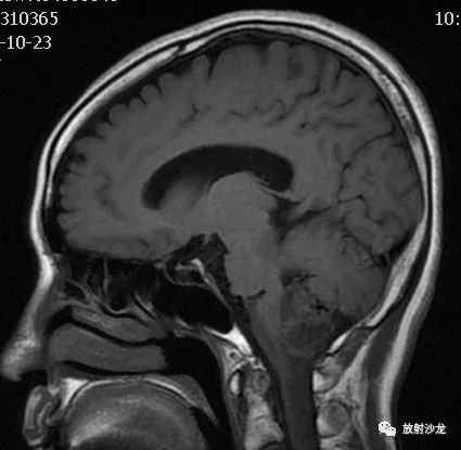 神经病例:后颅窝实性占位病变