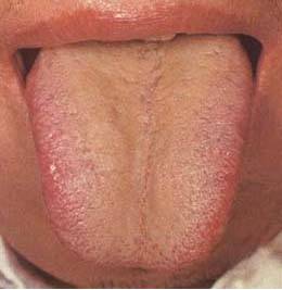 本图患者为肝癌,舌质红,舌苔黄厚腻,舌尖红点,提示湿邪与郁热交阻.