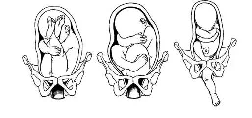 据"妈宝帮帮帮了解"胎位不正包括臀位,横位,枕后位,颜面位,额位等.