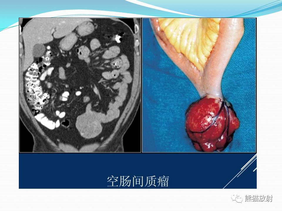 胃肠道间质瘤(gist)的影像诊断
