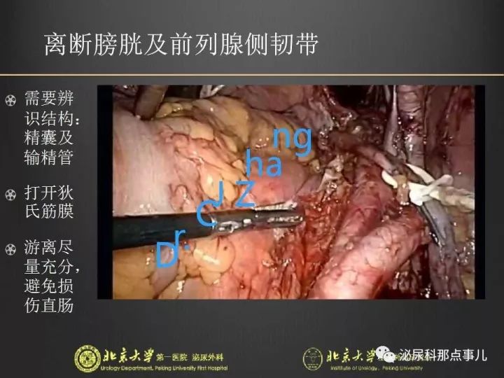 张崔建腹腔镜下尿路解剖膀胱根治性切除扩大淋巴清扫