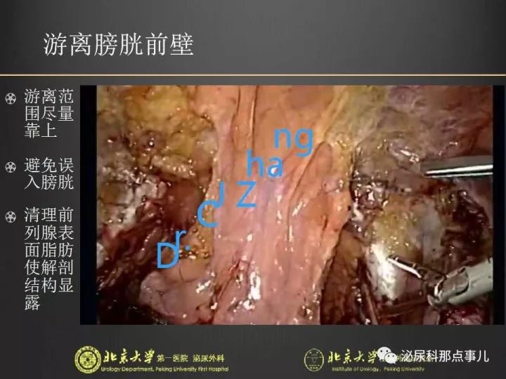 张崔建|腹腔镜下尿路解剖&膀胱根治性切除 扩大淋巴