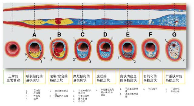 炎症反应与新生血管化 – 破坏纤维帽和斑块的稳定性