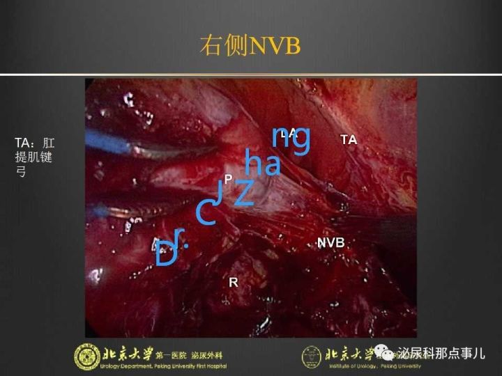 张崔建|腹腔镜下尿路解剖&膀胱根治性切除 扩大淋巴清扫