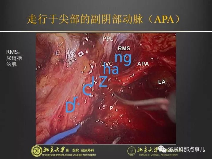 张崔建腹腔镜下尿路解剖膀胱根治性切除扩大淋巴清扫