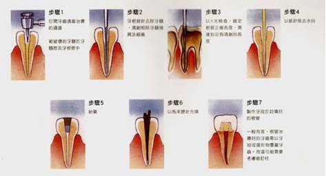 什么是乳牙根管治疗术