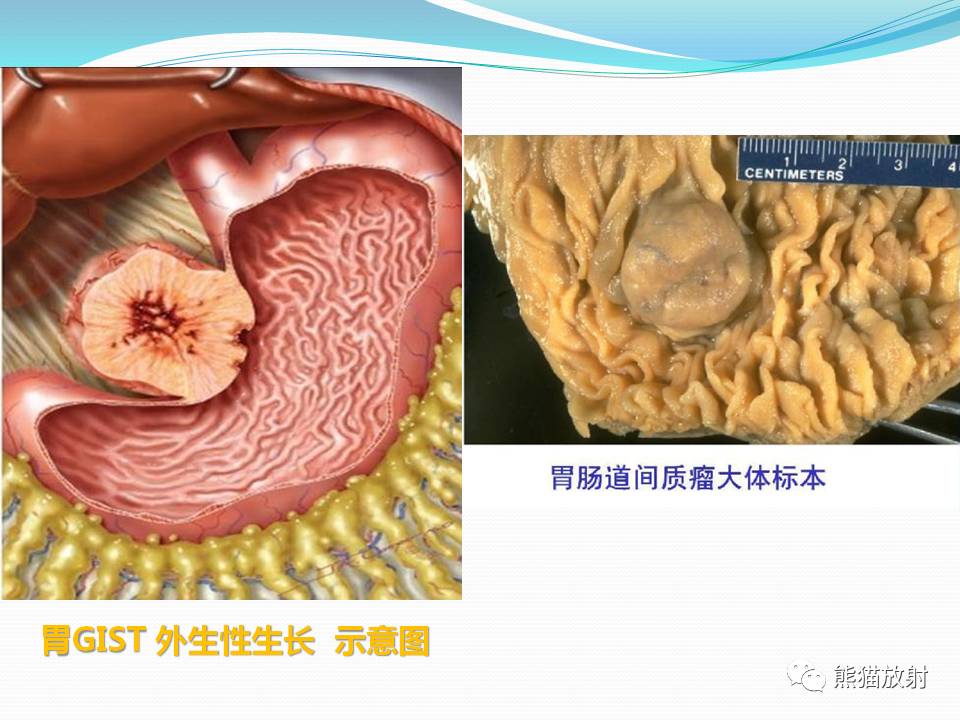 胃肠道间质瘤(gist)的影像诊断