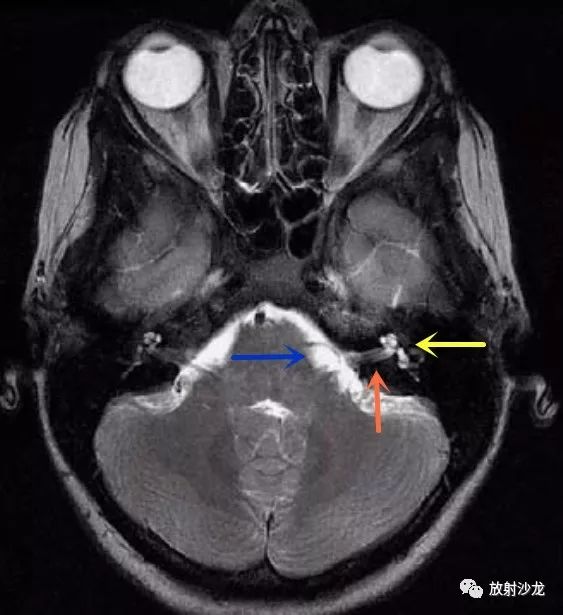 神经病例:桥小脑角区实性占位病变