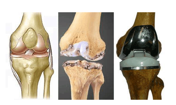 人工膝关节置换术风险大,术后做到这几点避免并发症