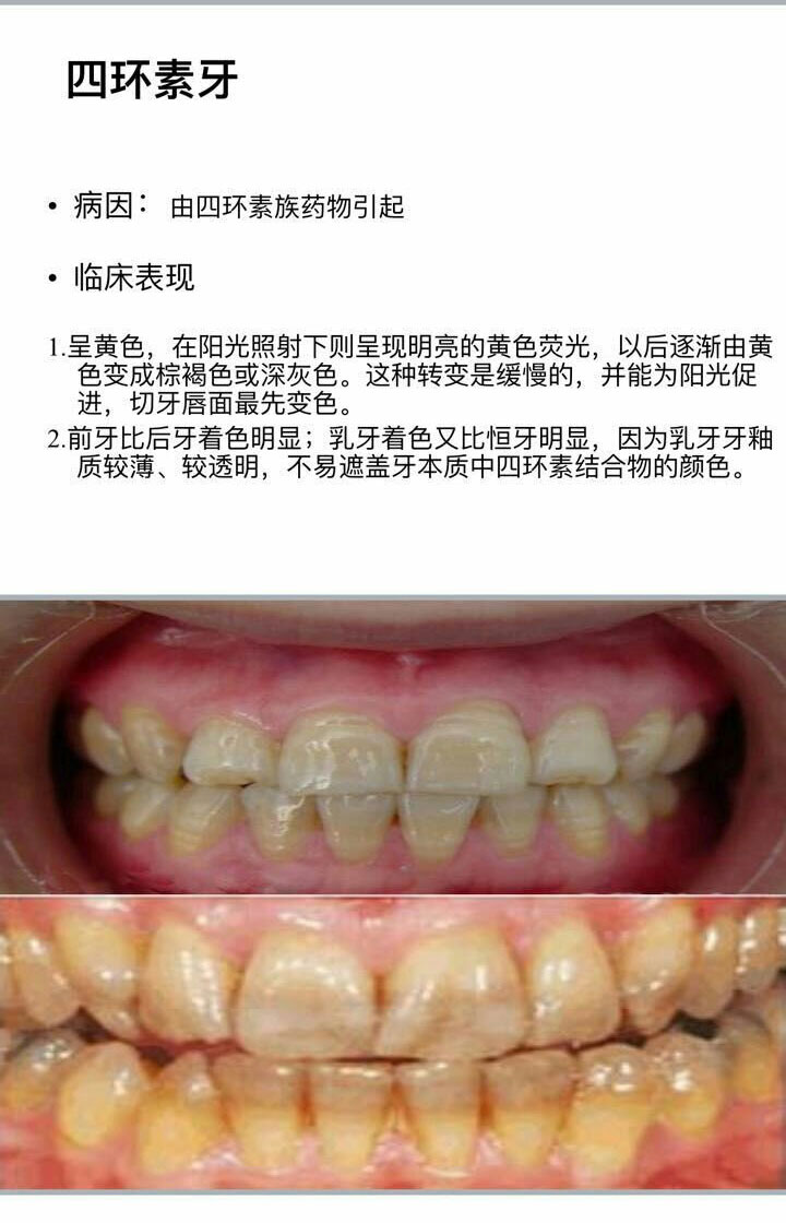 四环素牙是什么原因产生的