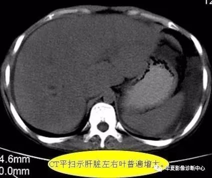 腹部ct基础读片36张,看完就都懂了