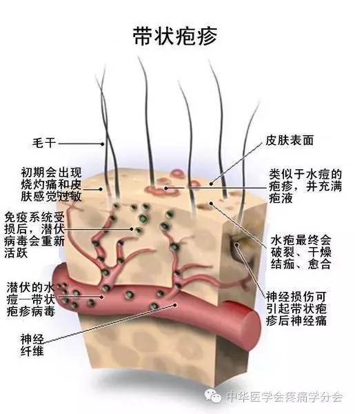 带状疱疹好发于中老年人还要当心后遗神经痛