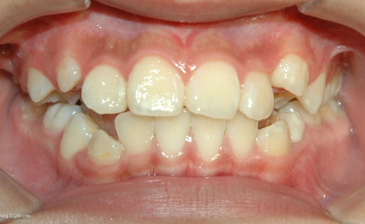 如果经常用舌头在同一个地方推动牙齿,那会造成牙根位置偏移,长时间