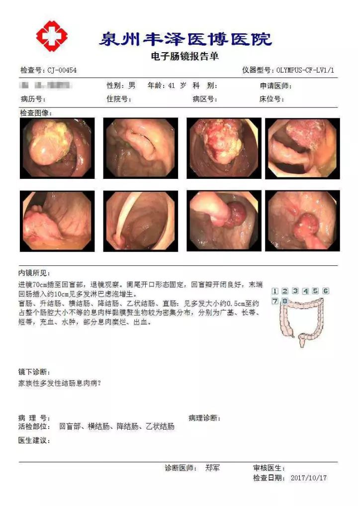 无痛电子肠镜检查报告单