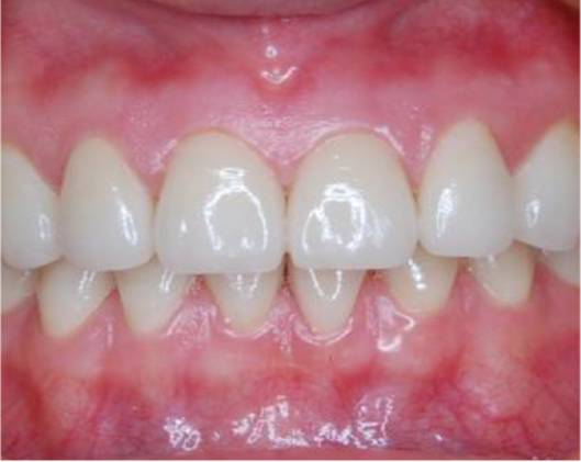 01 健康牙龈和不健康的牙龈 色泽:粉红色 形状:菲薄无肿胀 质地:坚韧