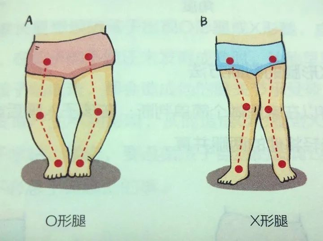 美国beaba:纸尿裤和"罗圈腿"的关系,4个字就能说清!