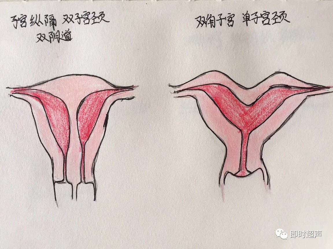 纵隔子宫:子宫底稍向外凸或轻微凹陷;子宫腔中部有分隔,分隔从子宫