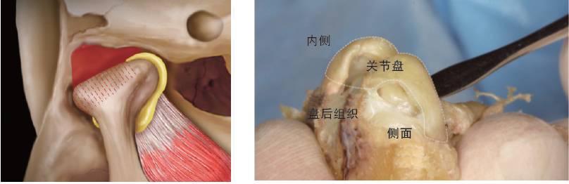 部分关节盘移位通常发生在髁突的外侧(piper分类Ⅲ型)(图2).