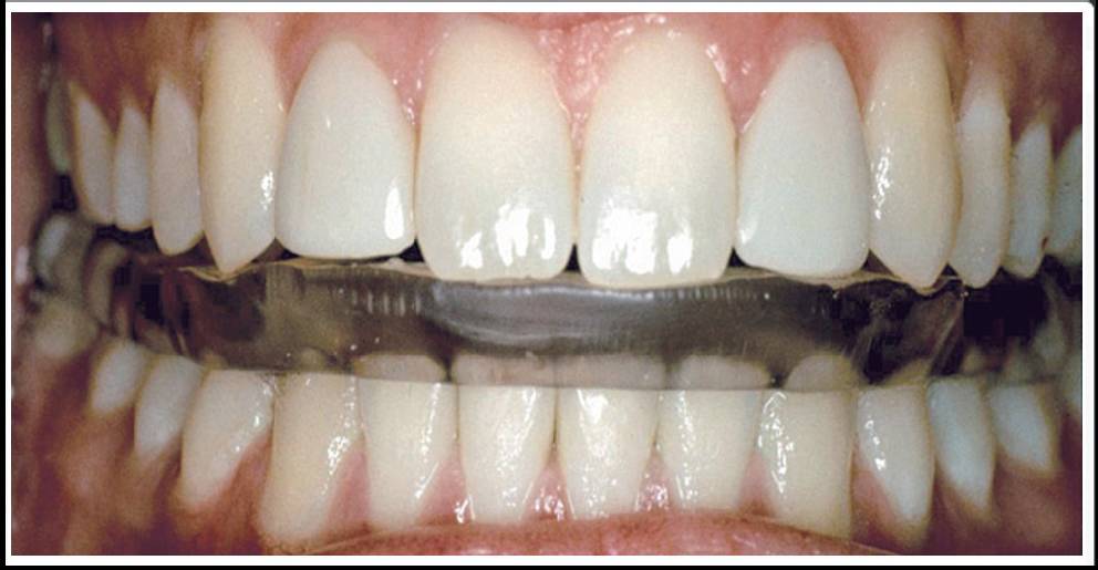 【功能修复】口颌系统疾病的合垫治疗方案及要点