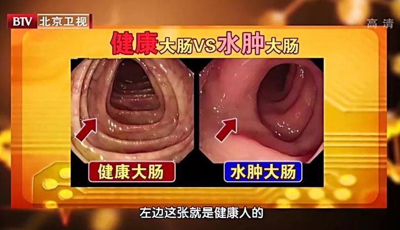 肠道水肿的罪魁祸首