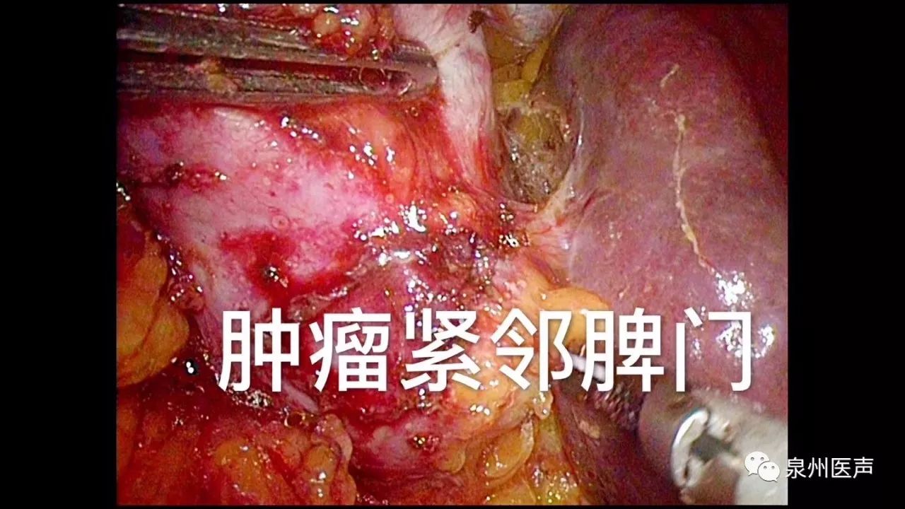 决定对患者进行 腹腔镜保留脾脏的 但胰腺解剖位置深在 与胃,十二指肠