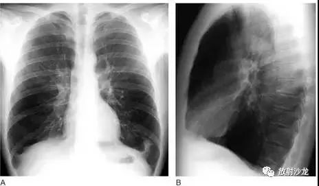 胸片上肺纹理的改变,都暗藏哪些玄机