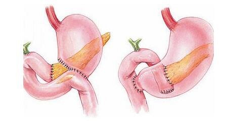 胰腺癌的腹痛部位为中上腹深处,常表现为持续进行性加剧的钝或钻痛.