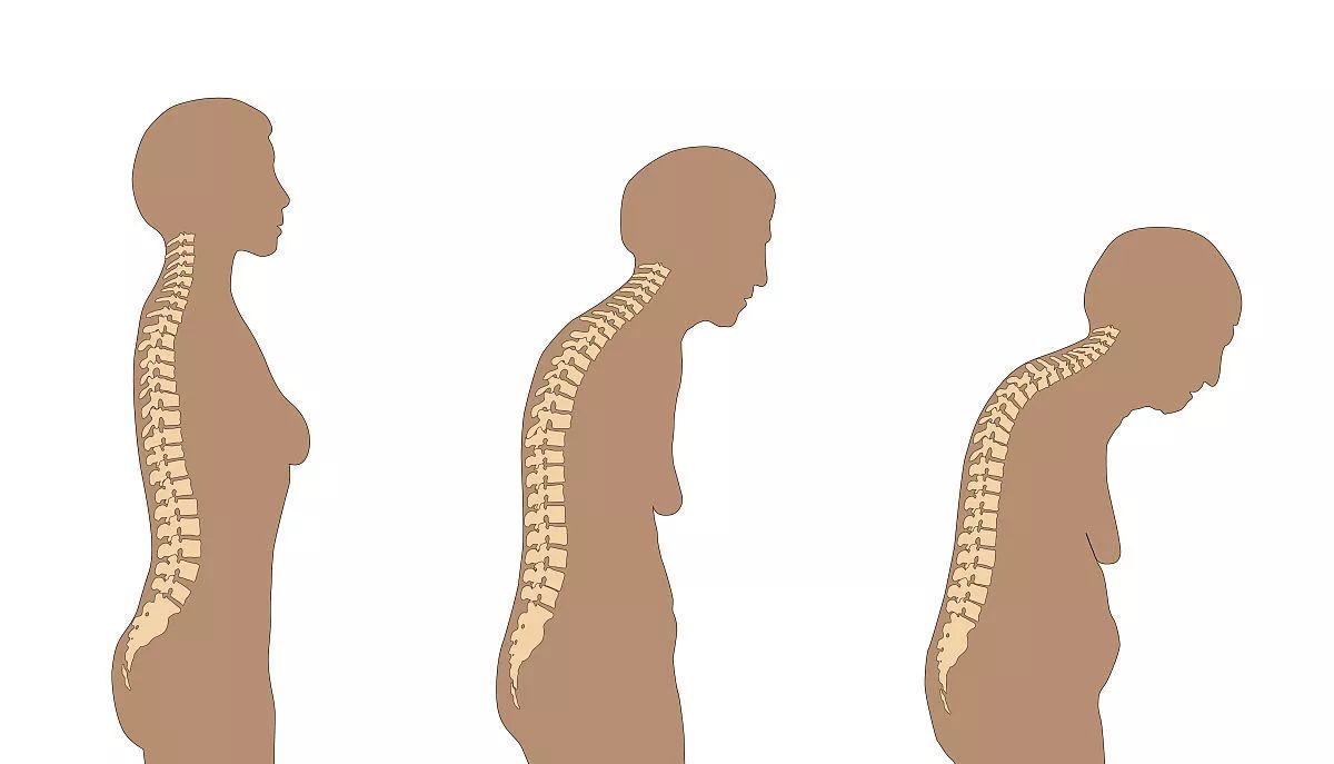 腰酸…背痛…变矮…驼背…一定要重视!别等骨头"酥"了