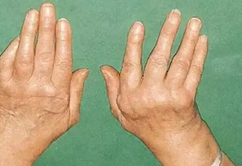 天鹅颈样畸形也往往发生在类风湿关节炎患者的手指部 ..