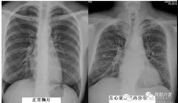 肺淤血多见于左心衰竭后肺静脉压力升高所致之肺静脉的扩张,表现为肺