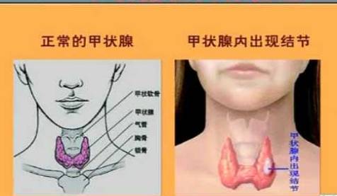 甲状腺疾病