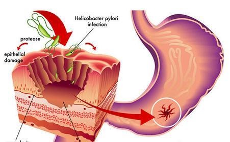 胃不好,有幽门螺旋杆菌吃这几种食物,让你的胃更轻松!