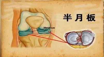 膝关节半月板为纤维软骨组织,充填于股骨髁与胫骨髁之间,有 半月板