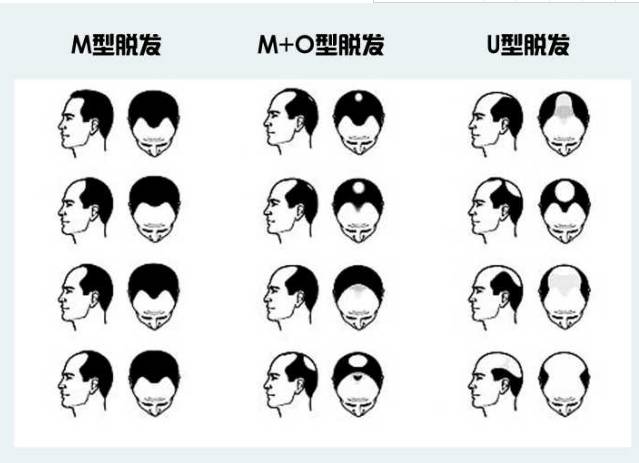 m型脱发大约需要1500——2500个毛囊