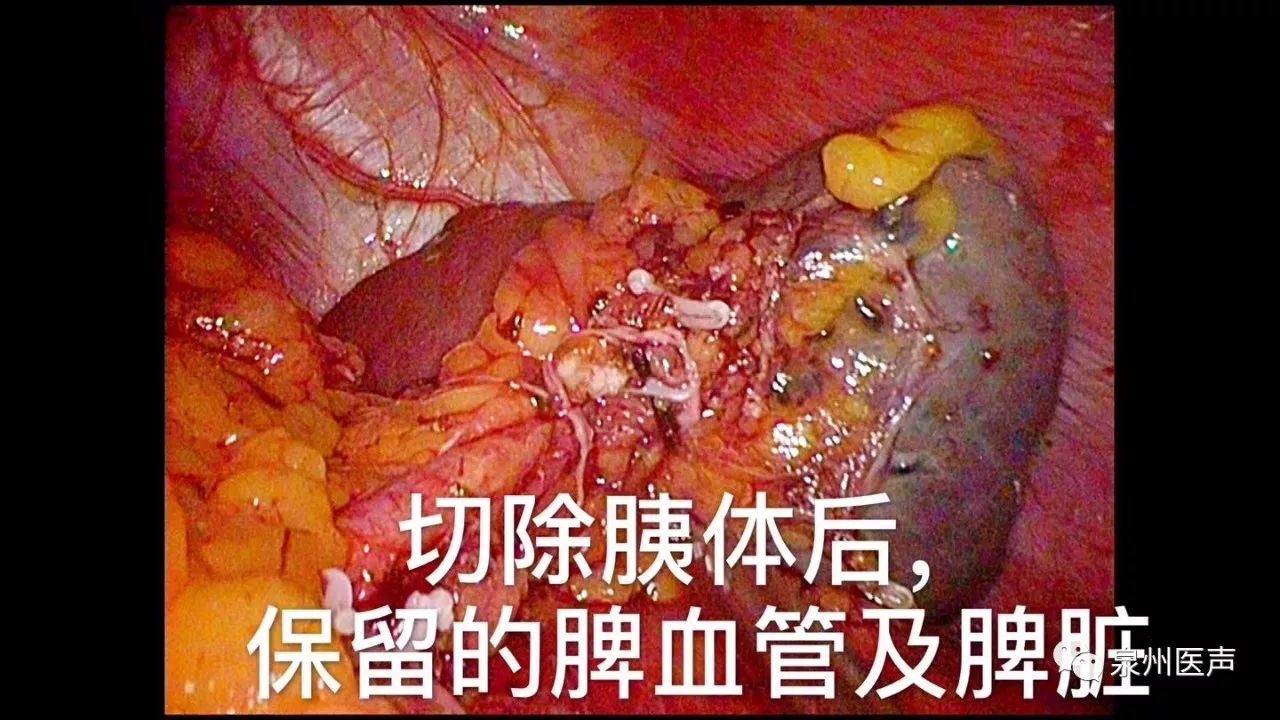 "钥匙孔"下"缉拿"胰腺肿瘤 复杂胰腺癌手术取得成功