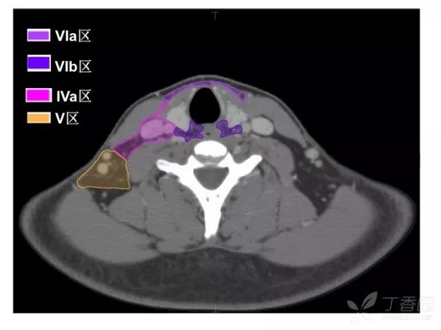 史上最精细:头颈部淋巴结分区 ct 图谱