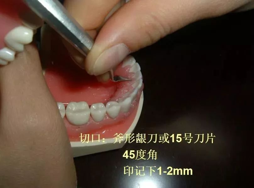 牙医技能松牙固定术