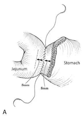 这种吻合方式可降低胰十二指肠切除术后延迟性胃排空发生率
