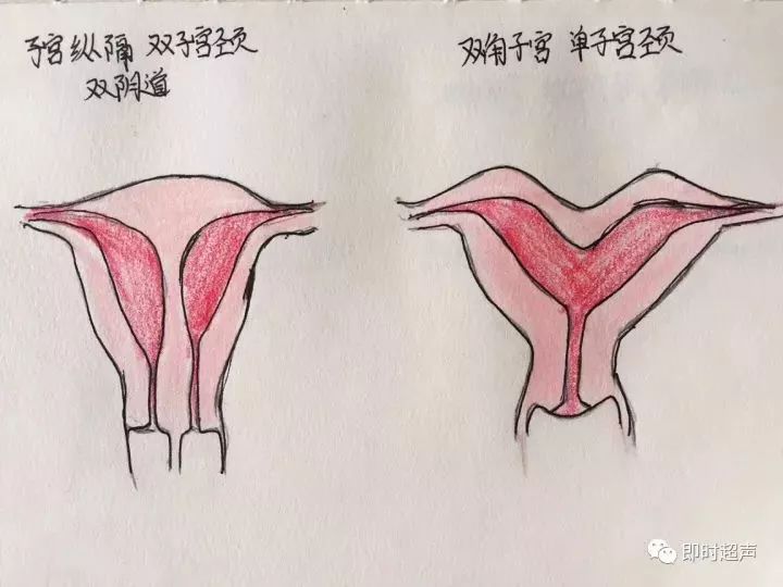 其中分隔止于宫颈内口以上部位诊断为不完全纵隔子宫,分隔达宫颈内口