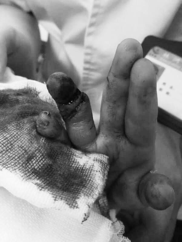 两岁男孩手指被压断,7天后手指成活,期间他们做了什么?
