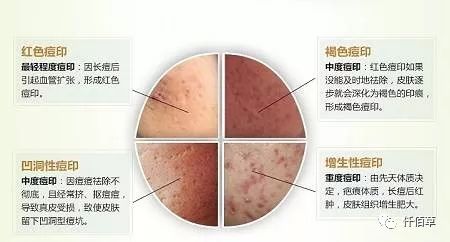 关于痘印痘坑你值得知道的事