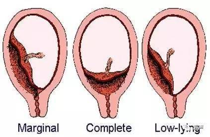 临床当中风险较大的,比如说中央性前置胎盘,胎盘完全覆盖宫颈内口