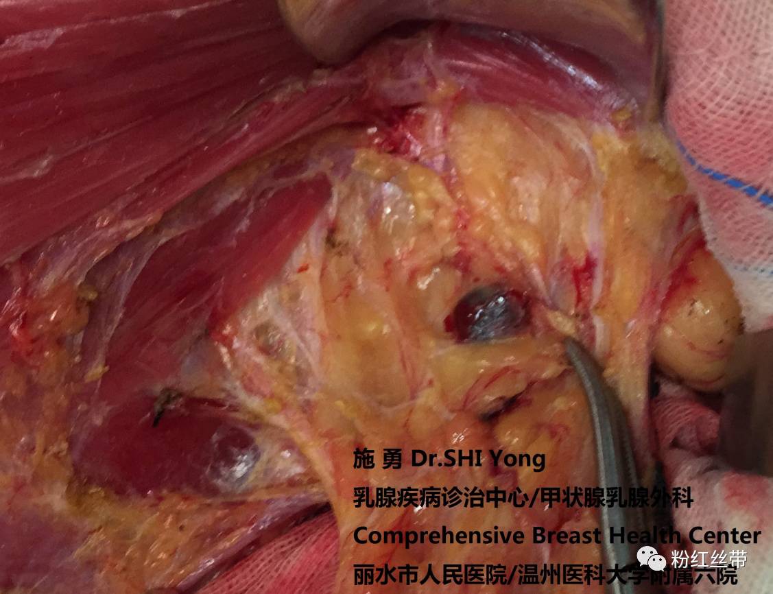 乳腺癌的规范手术及综合治疗该科以手术治疗为主的同时联合放疗,化疗