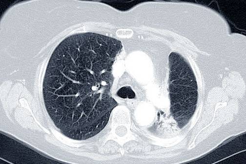 对于此病例,中央肿瘤(箭头)为小细胞肺癌.