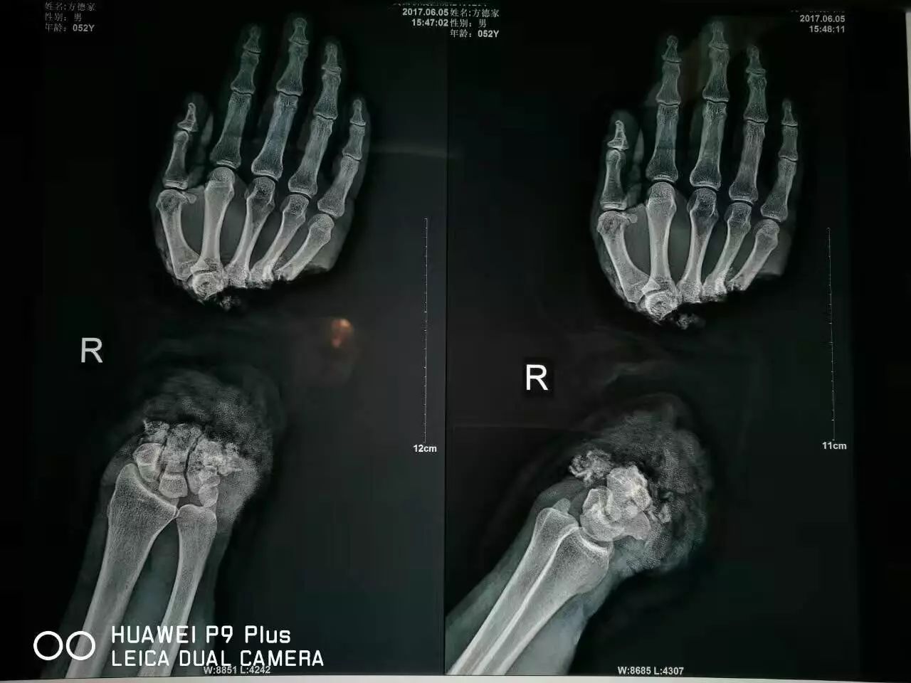 方师傅入院时的x光片