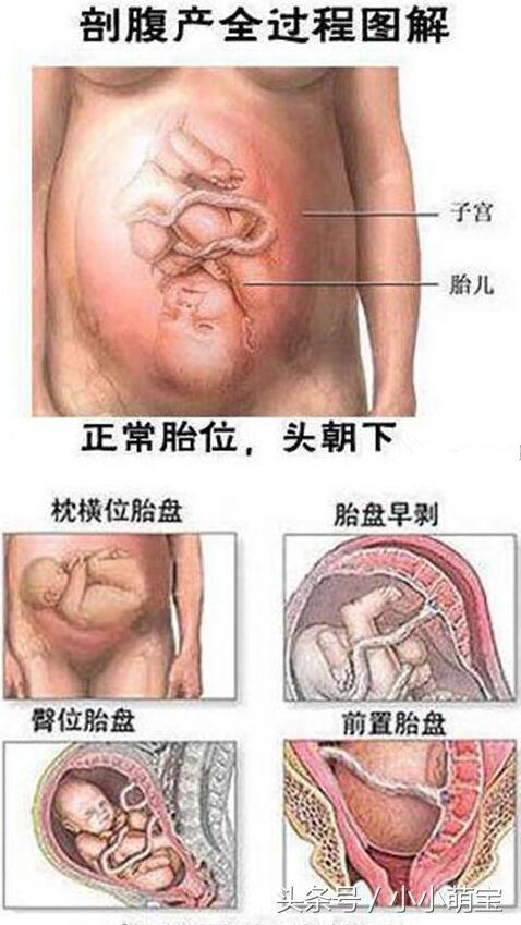 生孩子又分顺产和剖腹产,顺产的妈妈疼在前面,谁都说伟大,可是剖腹产