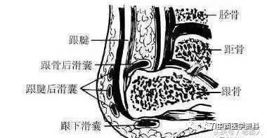 四 跟骨滑囊炎 足跟部共有三个滑囊:一个位于皮肤与跟腱之间,叫跟腱