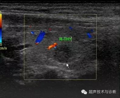 张惠,超声检查在甲状腺疾病诊断中的作用[j] 制作:超声技术与诊断