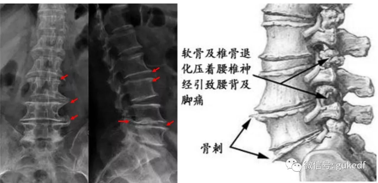 "骨刺"竟然是"好"东西?原来我们一直都"错怪"骨质增生