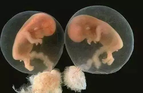 葡萄胎是指妊娠后胎盘绒毛滋生的细胞
